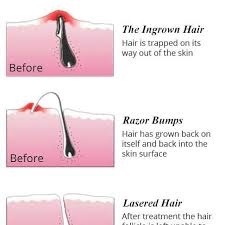 Dealing with ingrown hair on buttoms can be quite a complex task. Ever Got Painful Itchy Red Bumps Or Ingrown Hairs After Waxing Waxing Shaving Threading Cause Trauma To Hair Shaft Inside Your Skin Few Of Them Curls Inside The Skin And Fails To Come Out Causing