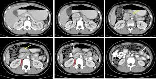 Image result for Midgut Volvulus