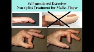 Mallet finger, also known as baseball finger, is an injury to the thin tendon that straightens the end joint of a finger or thumb. Mallet Finger Treatment