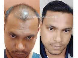 6.76 fl oz (pack of 1) 4.2 out of 5 stars. Meet India S Hair Growth Queen Dr Stuti Khare Shukla Times Of India