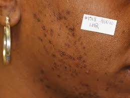 In one study , over 75% of people surveyed reported grooming their pubic area. Laser Hair Removal Before After Gallery Dover Oh Canton Oh Ohio Laser Wellness Centers
