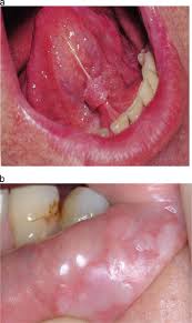 Image result for papillomavirus tongue)