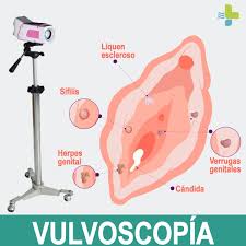 Las verrugas son tumores benignos duros sobre la piel. Dr David Estela Ginecologia Y Obstetricia La Vulvoscopia Es Un Examen Especializado Que Permite Identificar Lesiones Benignas O Malignas Que No Se Ven A Simple Vista En La Zona