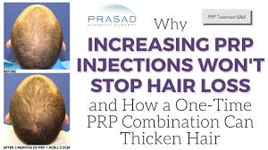 Apply the product at bedtime to wet hair and wash it out when you wake. Why Increasing Prp Injections Won T Stop Hair Loss And One Time Treatment To Thicken Hair