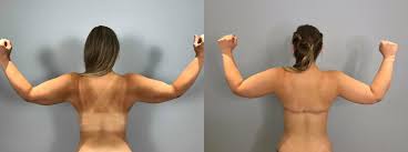 Back definition, the rear part of the human body, extending from the neck to the lower end of the spine. Salem Bra Line Back Lift Surgery Neaman Plastic Surgery