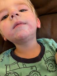 A lot of people in my life, pretty much everyone I meet, who hasn't seen me  have a reaction in real time, doesn't believe I'm highly allergic to red  40, and they