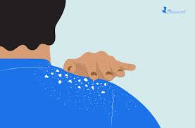 Psoriasis Skin Flakes Causes Treatments Coping