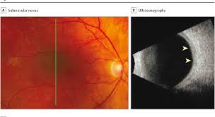 Image result for nevus sclerae