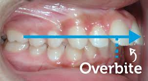 Most cases take 24 months. Overbite Corrected With Braces South Brunswick Nj