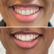 We did not find results for: Gummy Smile Treatment In Melbourne 150 At Cityskin