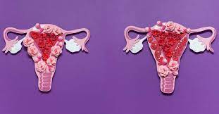 Learn more about the types, symptoms, causes, diagnosis, stages, treatment, and complications of endometriosis. Comment Savoir Si On Est Atteinte D Endometriose Le Guide Sante