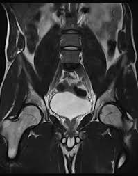 Image result for Hip Apophysitis