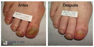 Los hongos de las uñas de los pies y la diabetes. Hongos En Unas Laser Care