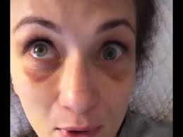 She currently fights for the ultimate fighting championship. A Look At Karolina Kowalkiewicz S Eye Post Ufc Auckland Youtube