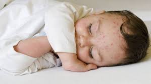 Image result for vyrážka u dětí