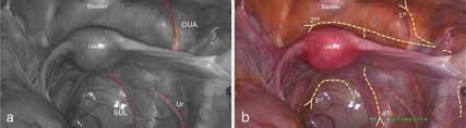 Maybe you would like to learn more about one of these? A Simplified Fascial Model Of Pelvic Anatomical Surgery Going Beyond Parametrium Centered Surgical Anatomy Springerlink