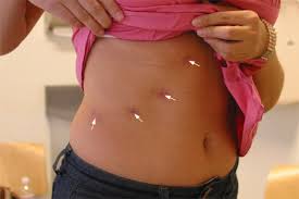 Scar Gallery Laparoscopic Adrenal Surgery Ucla Endocrine Center Los Angeles Ca