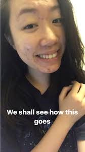 I Tried African Black Soap For Acne And It Didn't Do Much At All