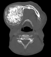 Ossifying Fibroma Ddx Fd Radiology Imaging Diagnostic Imaging Radiology