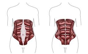 Your physical therapist will review your medical history and conduct a thorough interview about your condition. Fixing Diastasis Recti Post Pregnancy Belly In 10 Minutes Of Daily Exercise Shots Health News Npr