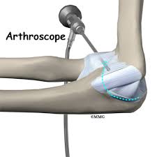 .of tommy john surgery may be incorrect with regard to the indications, operative technique, risks, recovery time, and benefits obtained from the procedure. Ulnar Collateral Ligament Reconstruction Tommy John Surgery Eorthopod Com