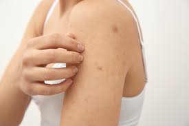 How To Get Rid Of Scabies Top 10 Remedies And Prevention Idea Hacks In 2020 Scabies Home Remedies For Scabies Scabies Treatment
