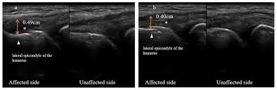 Image result for Epicondyle Injection