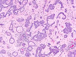 The gastrointestinal and breast protocols have been updated to reflect the revised who histologic types. Pathology Outlines Mesothelioma Versus Adenocarcinoma