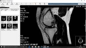 Mrt Bilder Was Ist Kaputt Gesundheit Arzt Knie