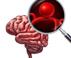 Un'emorragia cerebrale può ad esempio essere provocata da forti traumi cranici (incidenti stradali) o da condizioni, come emboli o malformazioni congenite, che minano. Emorragia Cerebrale Come Intervenire Fondazione Umberto Veronesi