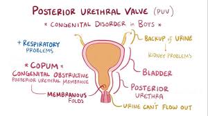 Posterior Urethral Valve