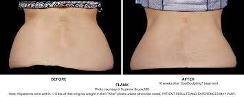 How To Get Rid Of Love Handles | Fat Reduction Coolsculpting