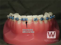 Around the age of five teeth slowly fallout to create path for permanent • many children get thrilled regarding losing tooth, particularly if you're planning the tooth fairy path some others could be scared that losing a tooth are going to feel painful or that there is going to be a. Braces Care Guide Frequently Asked Questions About Braces Grand Rapids Orthodontists