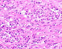 However diagnosing desmoplastic mesothelioma can be tricky. Pathology Outlines Diffuse Malignant Mesothelioma