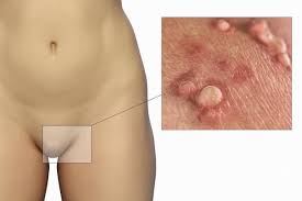 Image result for genital warts
