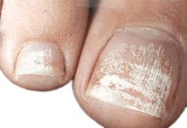 White Toenail Fungus Symptoms Causes Treatment Http Www Yellowtoenailscured Com White To White Toenail Fungus Toenail Fungus Remedies Nail Fungus Cure