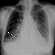 Bacterial pneumonia is an infection of your lungs caused by certain bacteria. Https Docs Bvsalud Org Biblioref 2018 04 882682 Interpretando A Radiografia De Torax Na Emergencia Pdf