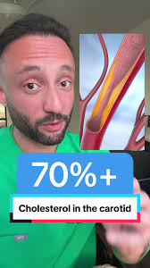 Understanding Atherosclerosis and Stroke Risk