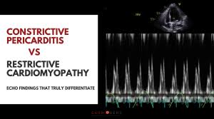 Image result for Restrictive Cardiomyopathy