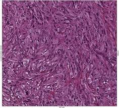 We did not find results for: Comprehensive Molecular And Pathologic Evaluation Of Transitional Mesothelioma Assisted By Deep Learning Approach A Multi Institutional Study Of The International Mesothelioma Panel From The Mesopath Reference Center Journal Of Thoracic Oncology