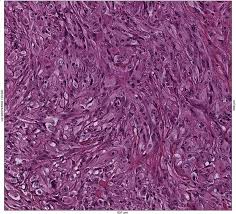 Most tumors arise from the pleura, and so this article will focus on pleural mesothelioma. Comprehensive Molecular And Pathologic Evaluation Of Transitional Mesothelioma Assisted By Deep Learning Approach A Multi Institutional Study Of The International Mesothelioma Panel From The Mesopath Reference Center Journal Of Thoracic Oncology