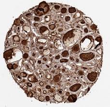 Precipitation of protein in the renal tubules. Ihc Human Oncotargets Dianova