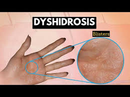 Image result for dyshidrosis