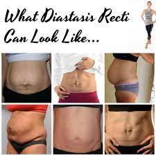 We did not find results for: Pin On Diastasis Recti
