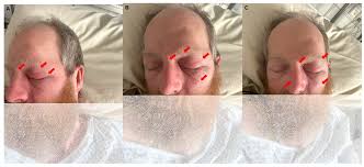 Image result for phlegmon on face)