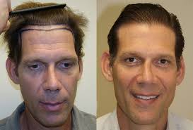 Natural Hair Loss Treatment in Alabama Bibb Brent