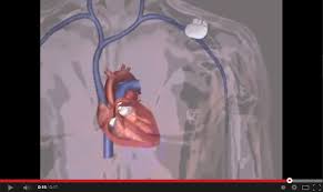 The pacemaker may not work properly and not deliver therapy as expected. How Pacemakers Work Boston Scientific