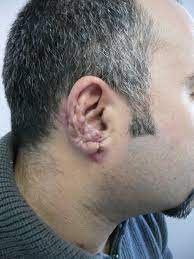 A technique for the reconstruction of. Partial Avulsion Of The Right Ear Treated With A Pocket Technique A Case Report And Review Of The Literature Abstract Europe Pmc