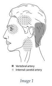 The pain comes and goes. answered by dr. A Real Pain In The Neck Cervical Artery Dissection Emergency Medicine Board Review