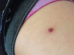 Bouton De Sang Acne Acne Psoriasis Et Problemes De Peau Forum Sante Doctissimo